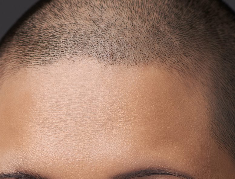 Scalp Micropigmentation in Winston-Salem, North Carolina