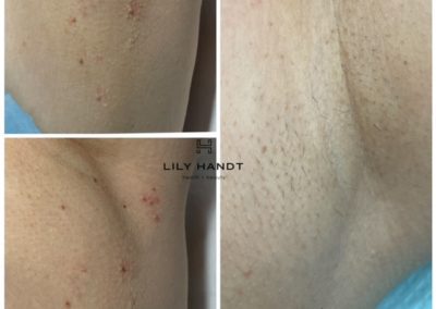Skin Tag Removal
