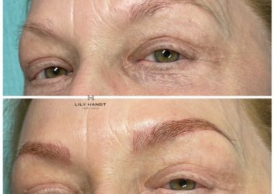 Dark Spot Removal