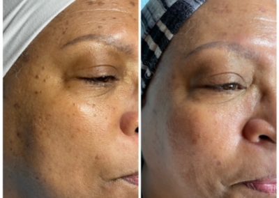 Dark Spot Removal