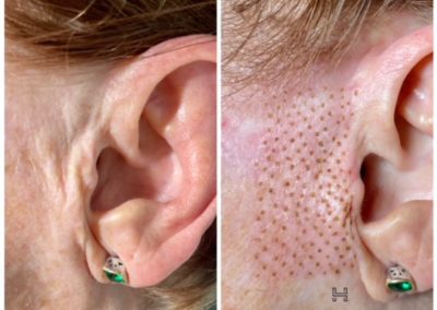 Nonsurgical Skin Lift