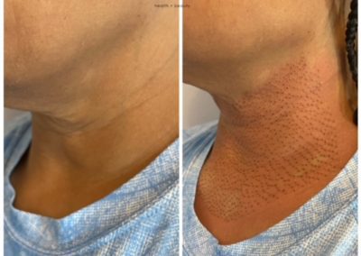 Nonsurgical Skin Lift