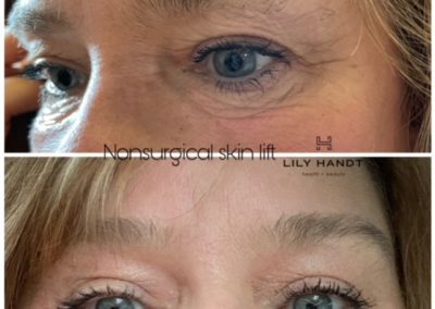 Nonsurgical Skin Lift