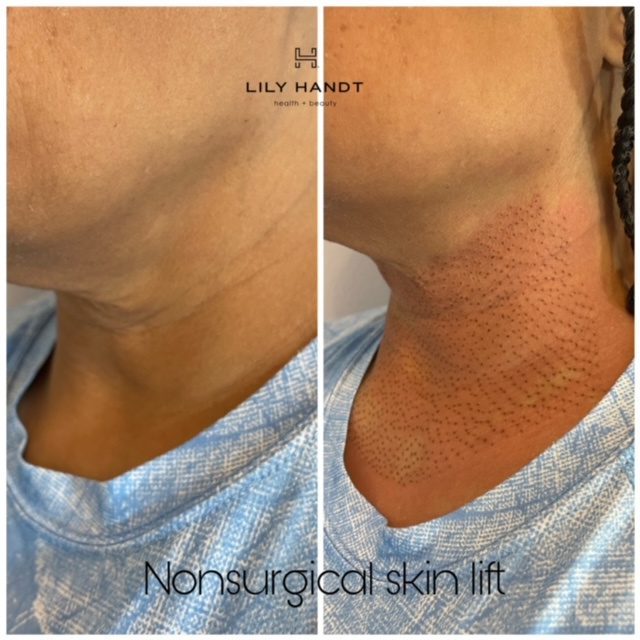 Non-Surgical Skin Lift in Winston-Salem, North Carolina